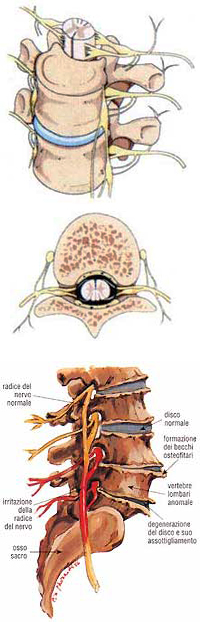 Degenerazione della sublussazione